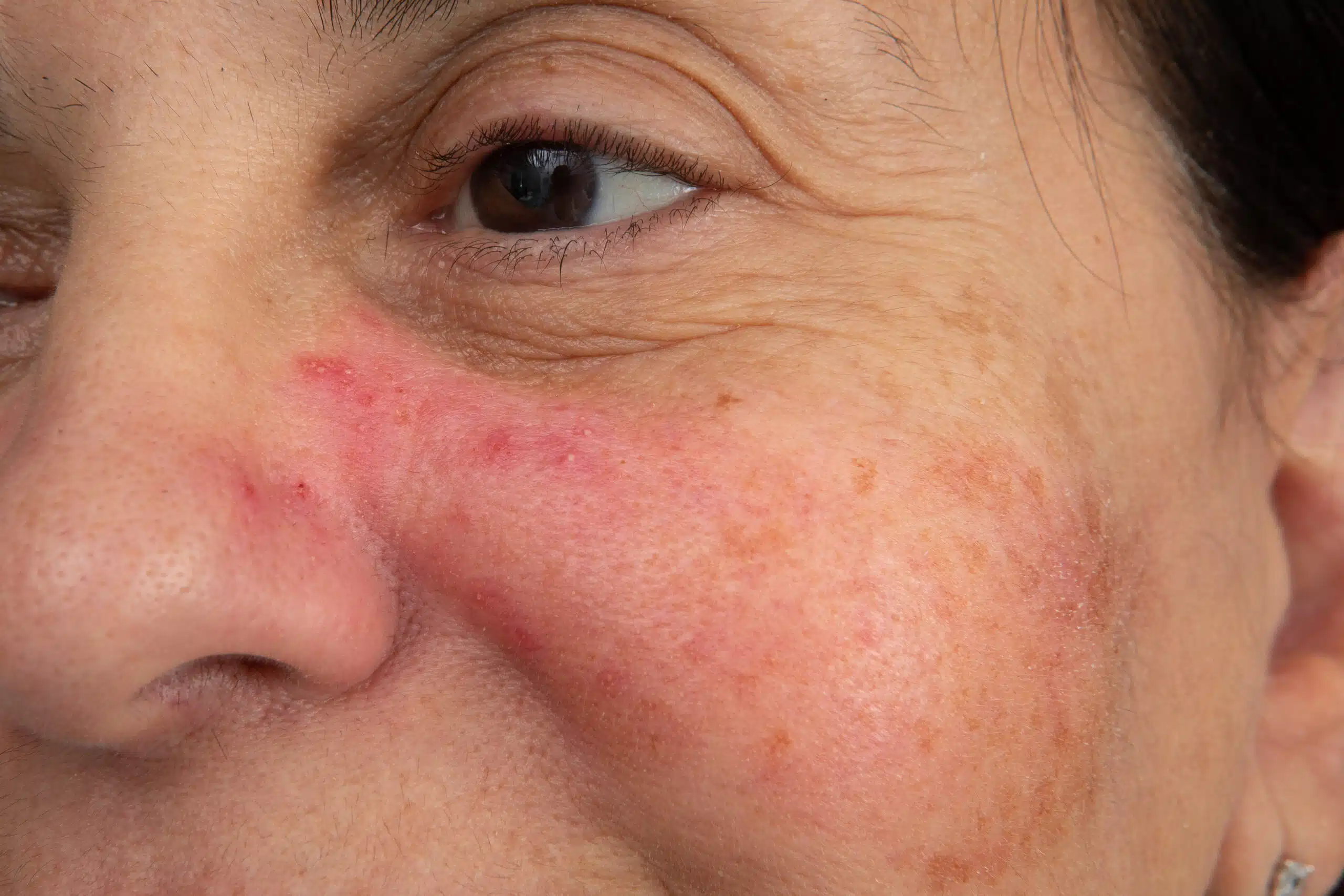 Rosacée visage Skin Marceau Paris