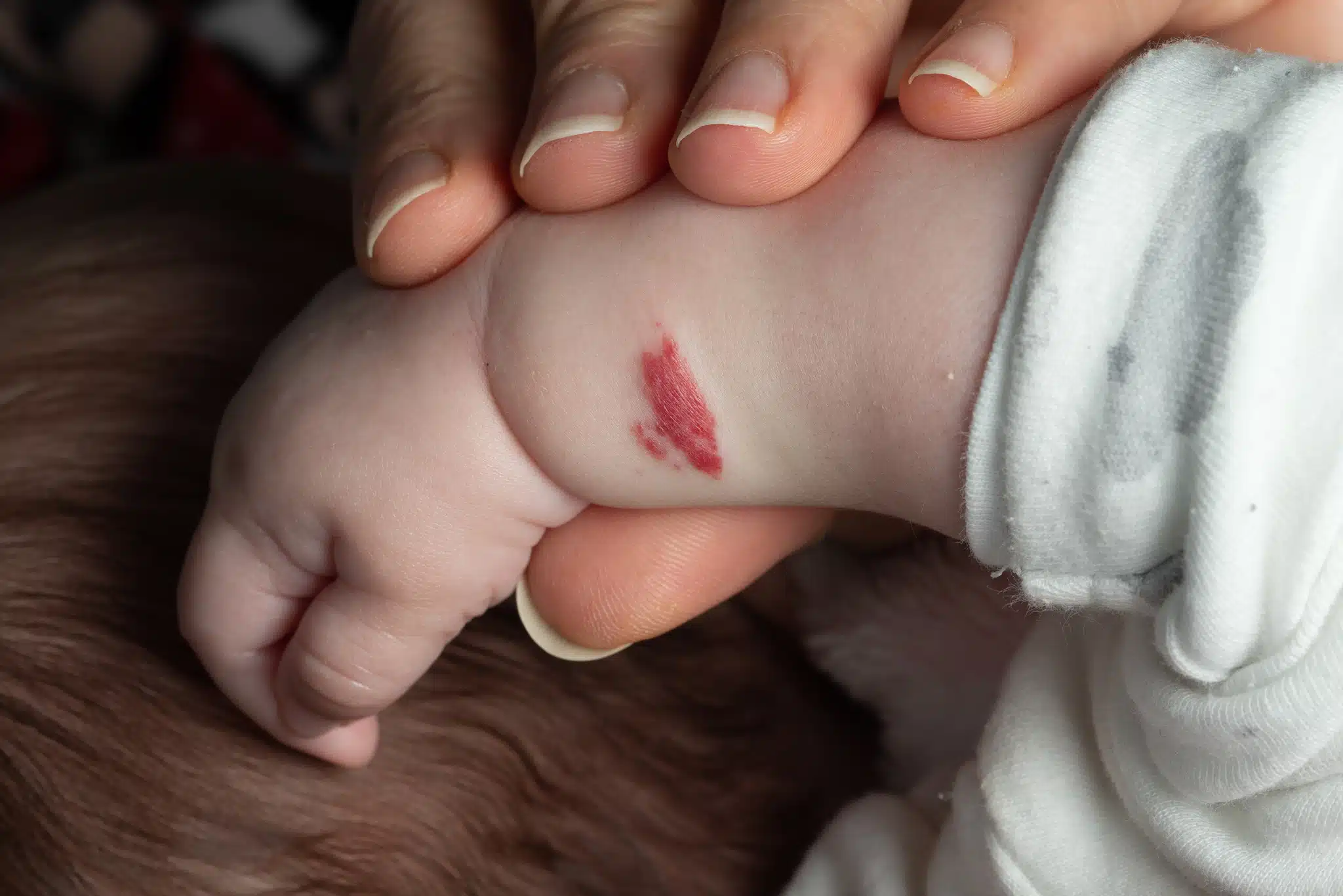 hémangiome bebe