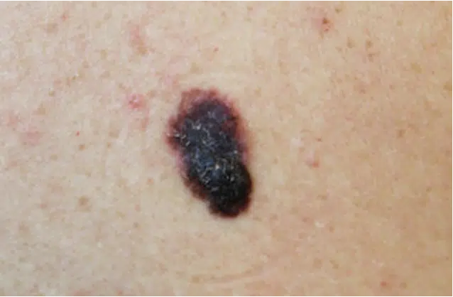 melanome
