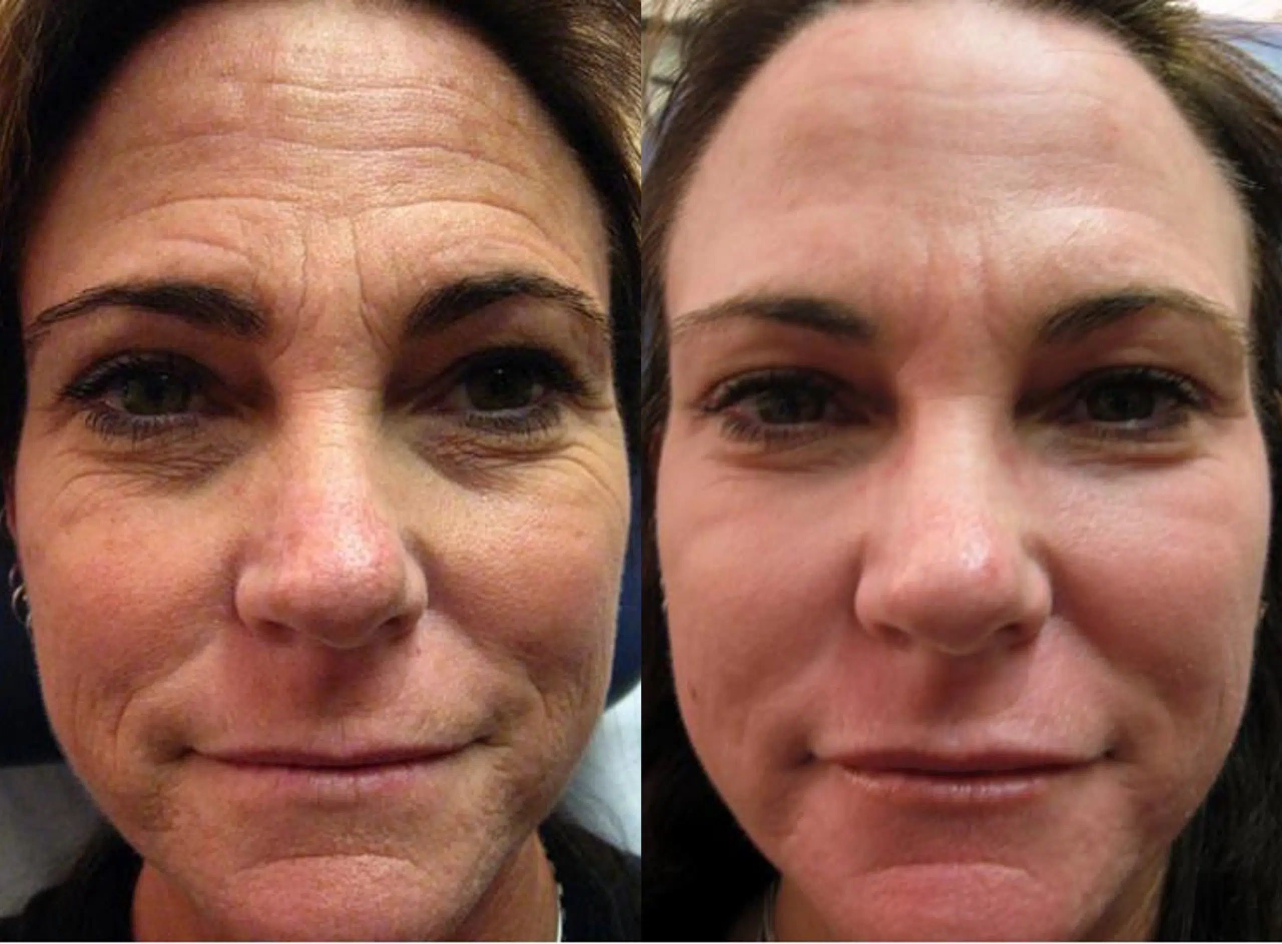 Laser skin resurfacing CO2 fully ablative Ultrapulse