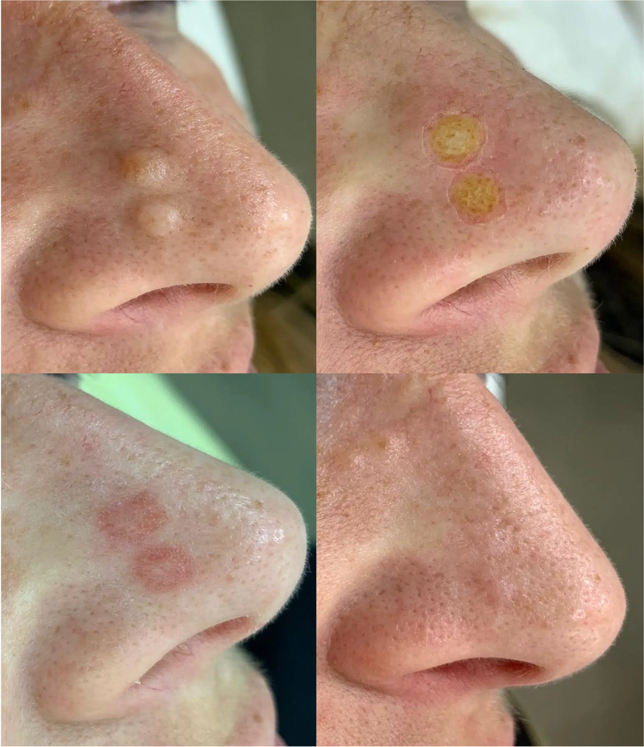 Papule-Fibreuse-du-Nez-photo-traitement-laser-Skin-Marceau