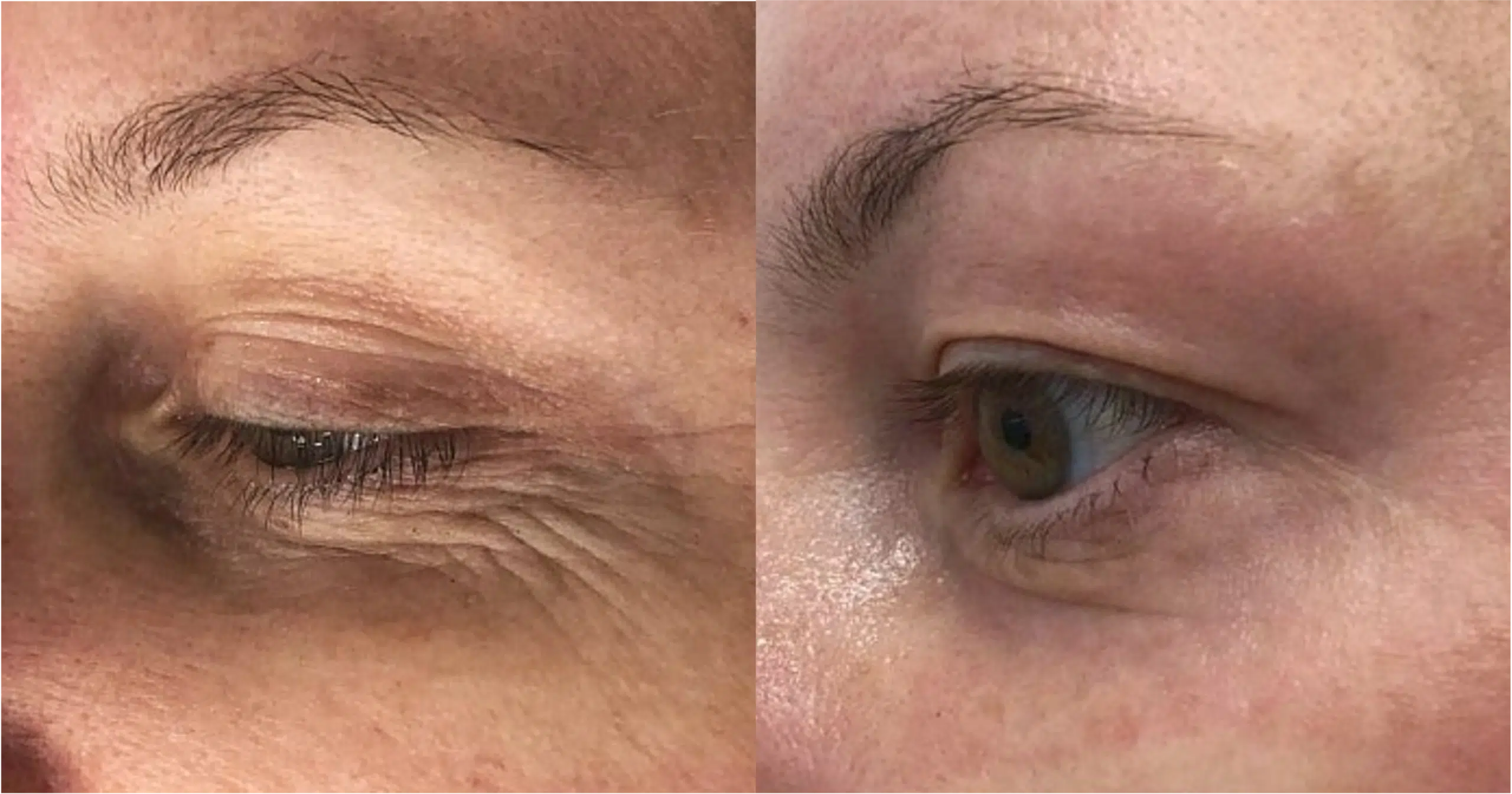 laser eyelid CO2 Paris Skin Marceau tightening Ultrapulse