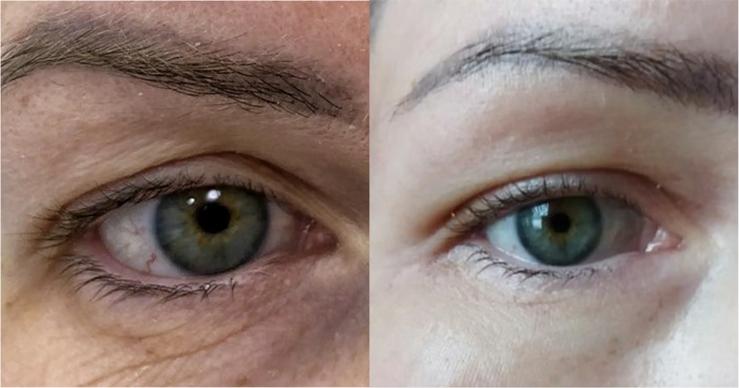 laser eyelid CO2 Paris Skin Marceau tightening Ultrapulse