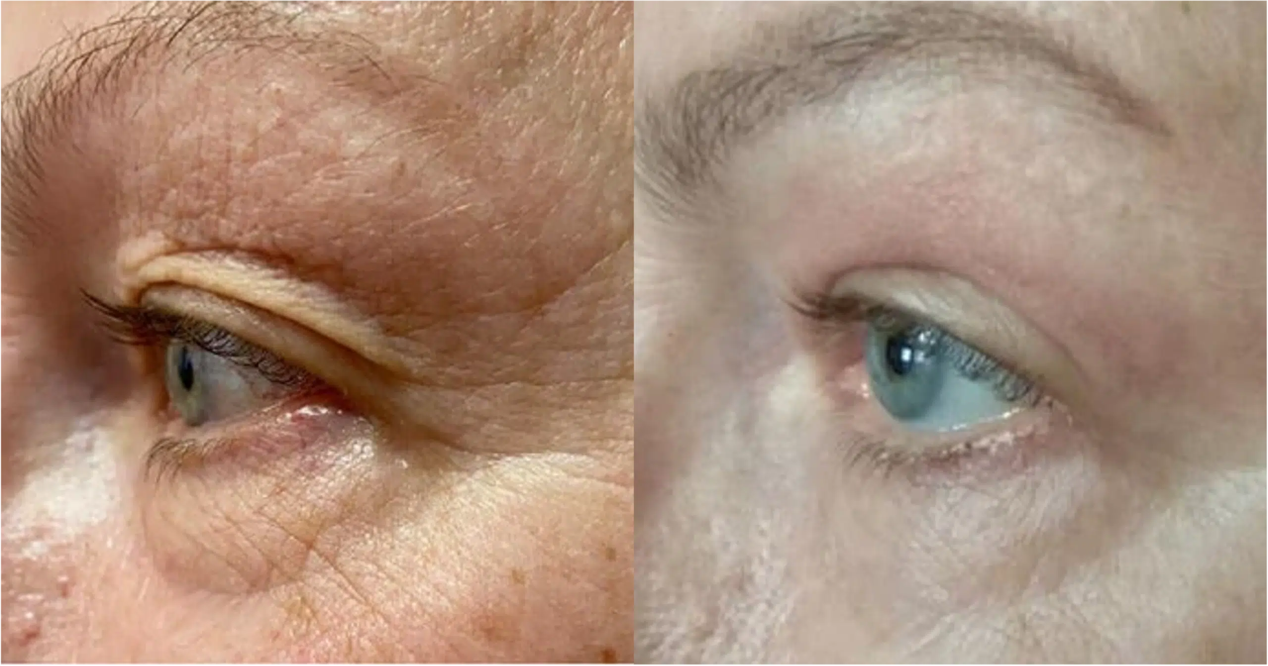 laser eyelid CO2 Paris Skin Marceau tightening Ultrapulse