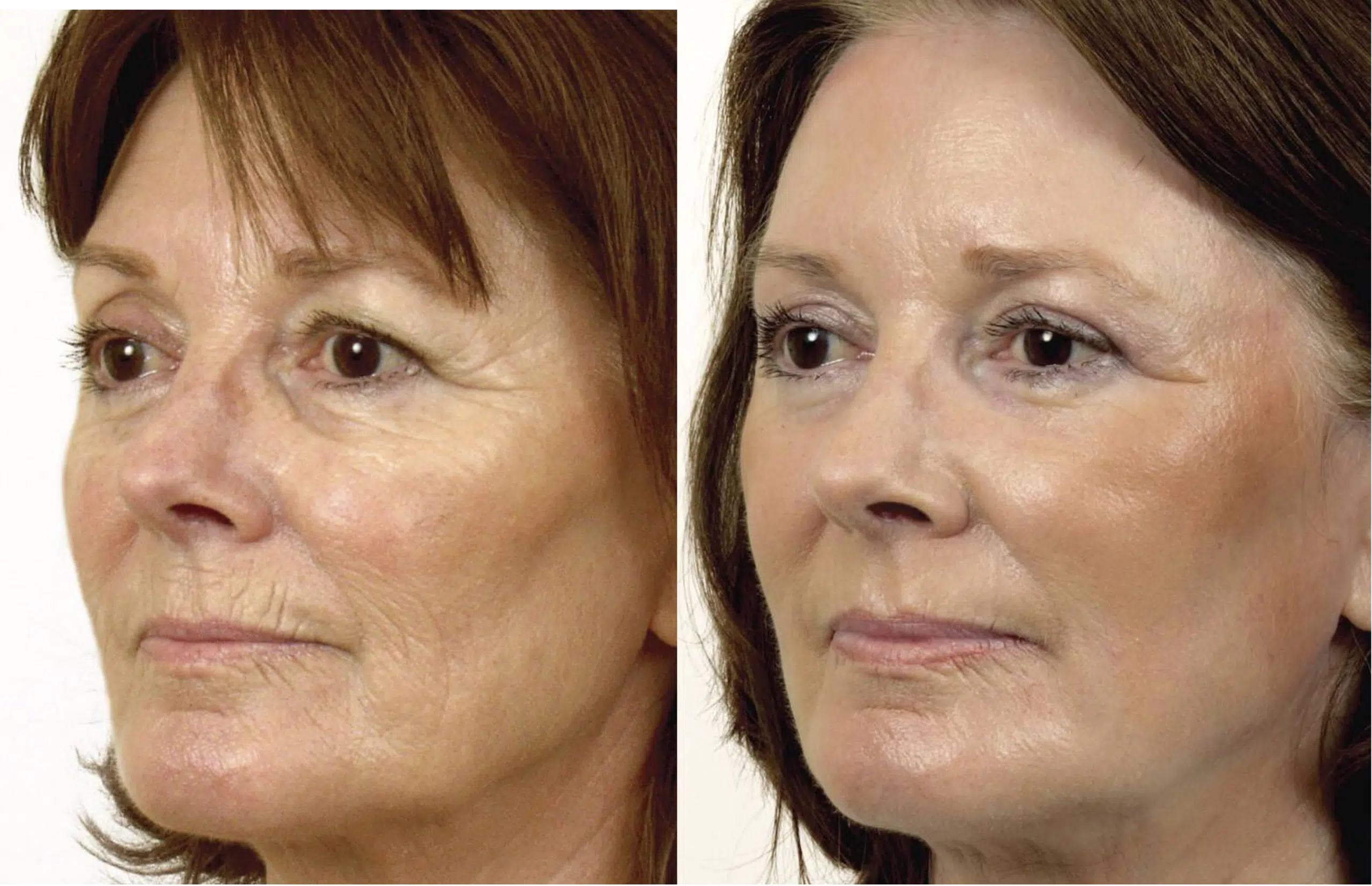 laser resurfacing resurfacage Paris Skin Marceau ablatif complet 2