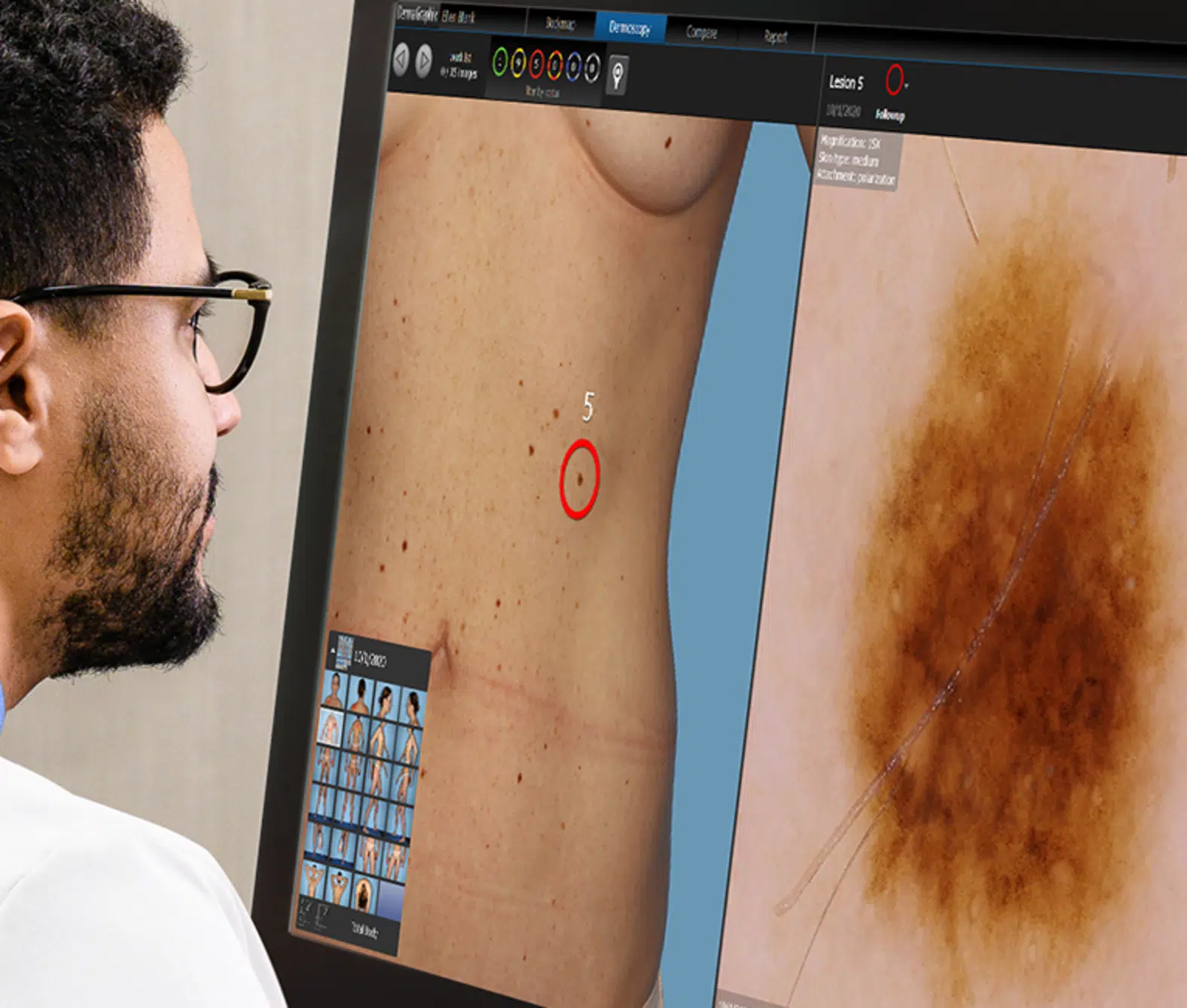 dermatoscopie IA dépistage cancer de la peau Skin Marceau cartographie
