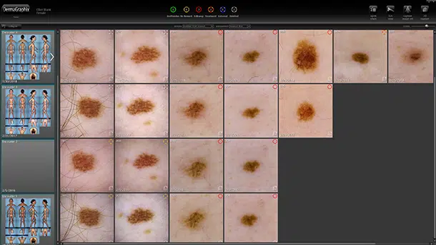 dermatoscopie IA dépistage cancer de la peau Skin Marceau 2