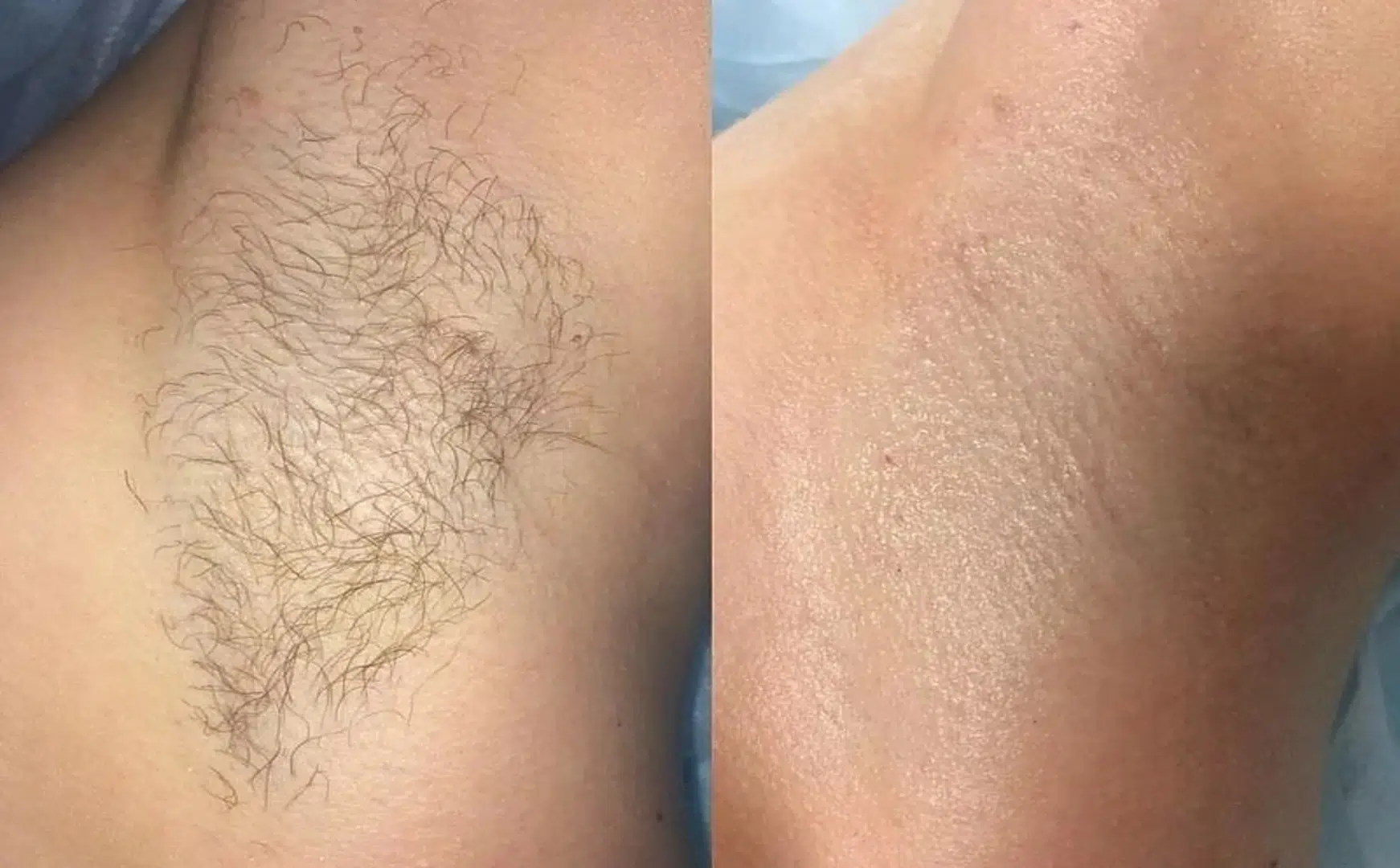 épilation laser avant après aisselles