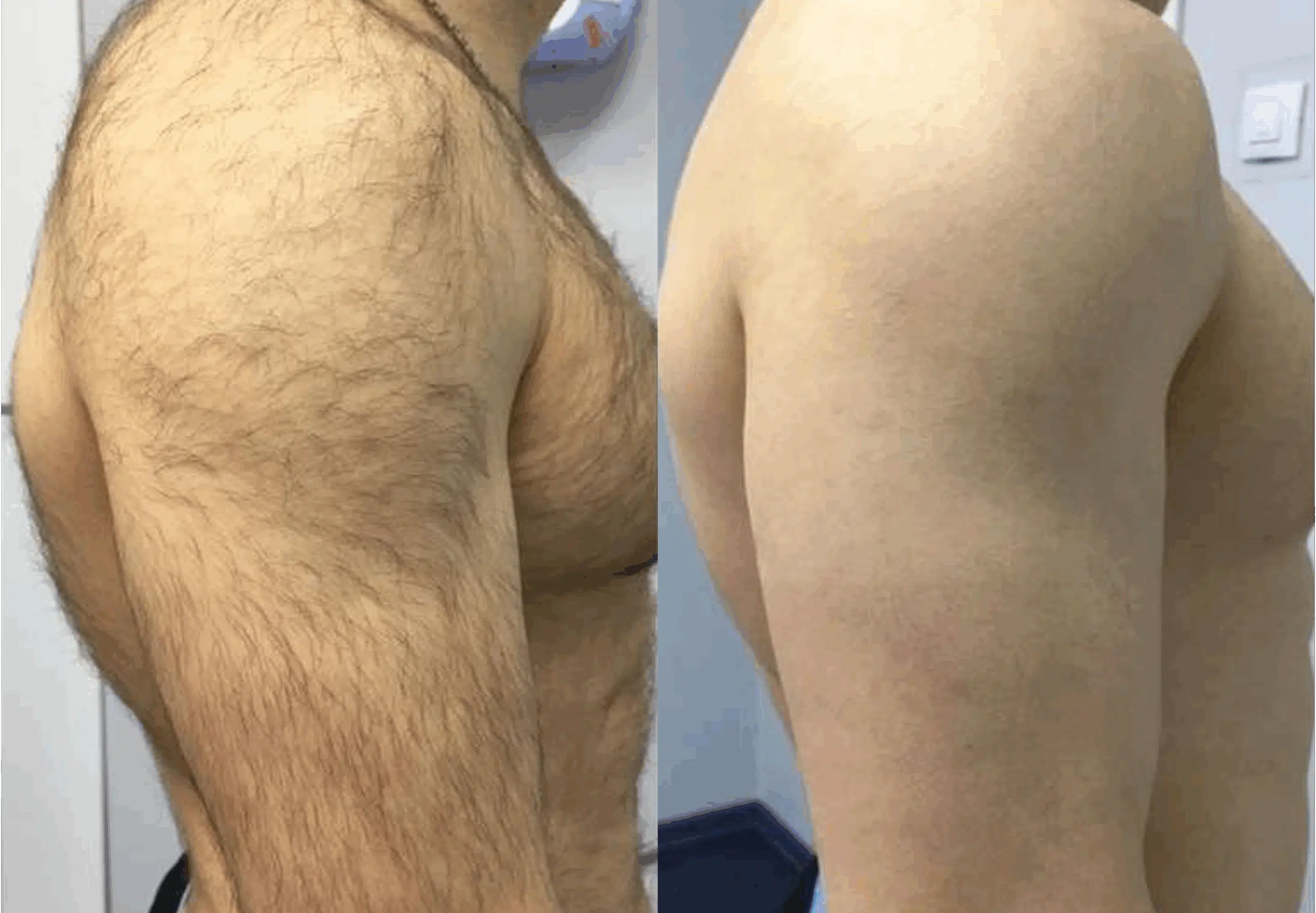 épilation laser homme avant après